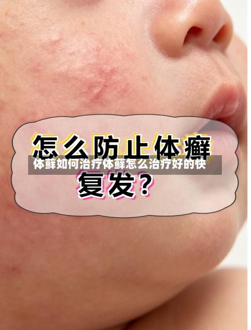体藓如何治疗体藓怎么治疗好的快