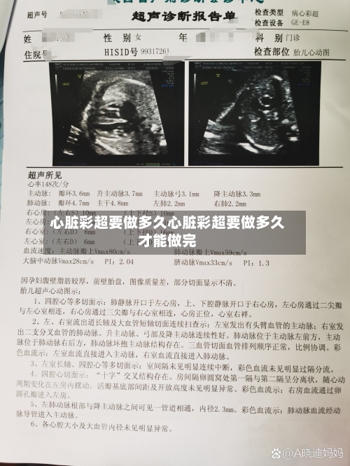 心脏彩超要做多久心脏彩超要做多久才能做完