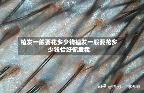 植发一般要花多少钱植发一般要花多少钱恰好你爱我